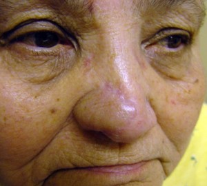 After-Nose Reconstruction
