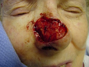 Before-Nose Reconstruction