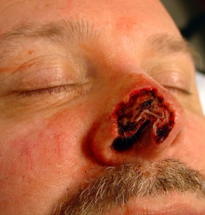 Before-Nose Reconstruction