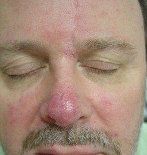 After-Nose Reconstruction