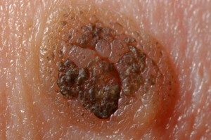 Skin Cancer Screening in San Ramon, CA