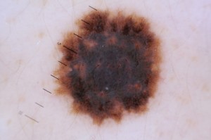 Skin Cancer Screening in San Ramon, CA