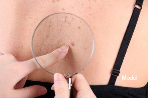 Skin Cancer Screening in San Ramon, CA
