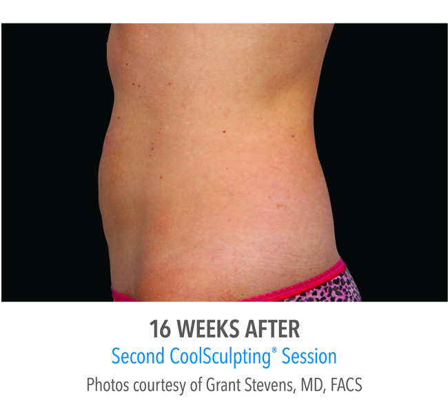 After-CoolSculpting