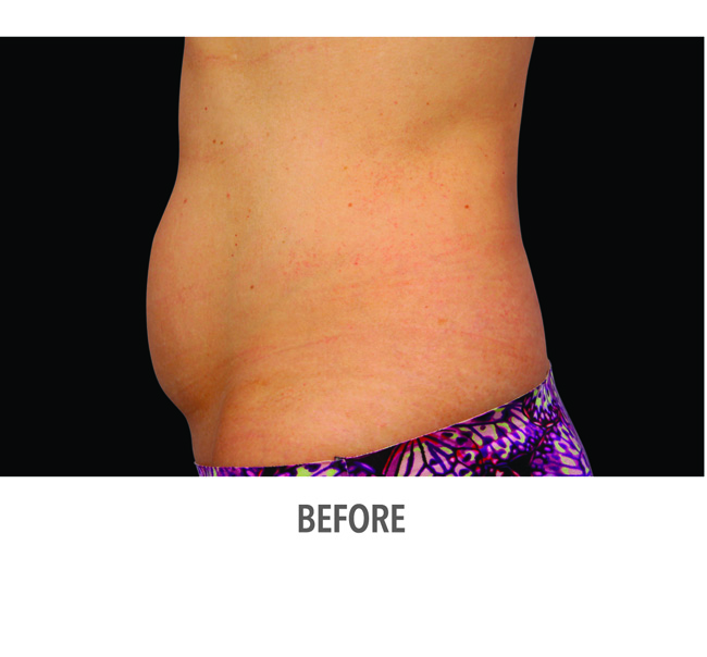 Before-CoolSculpting