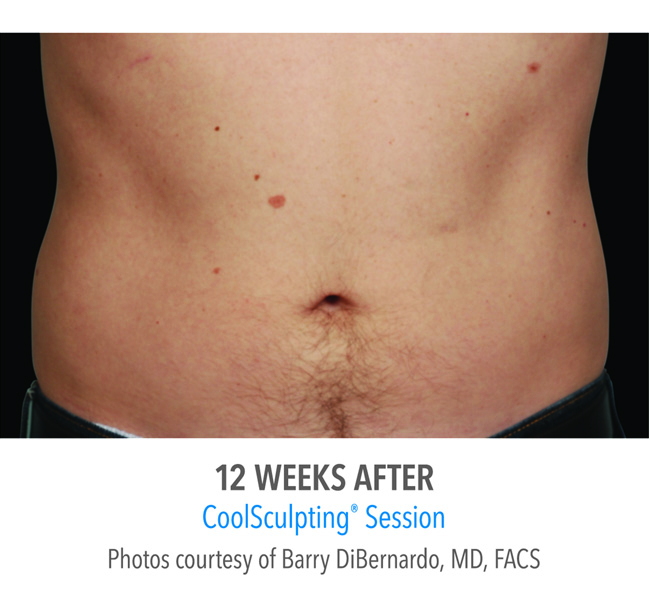 After-CoolSculpting