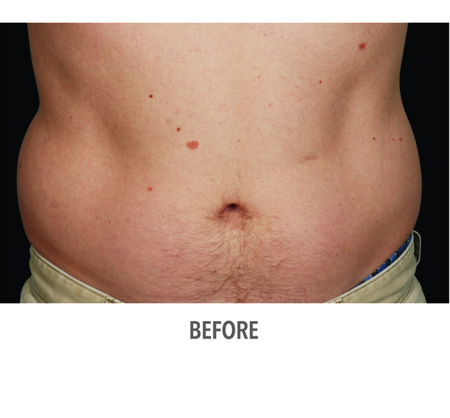 Before-CoolSculpting