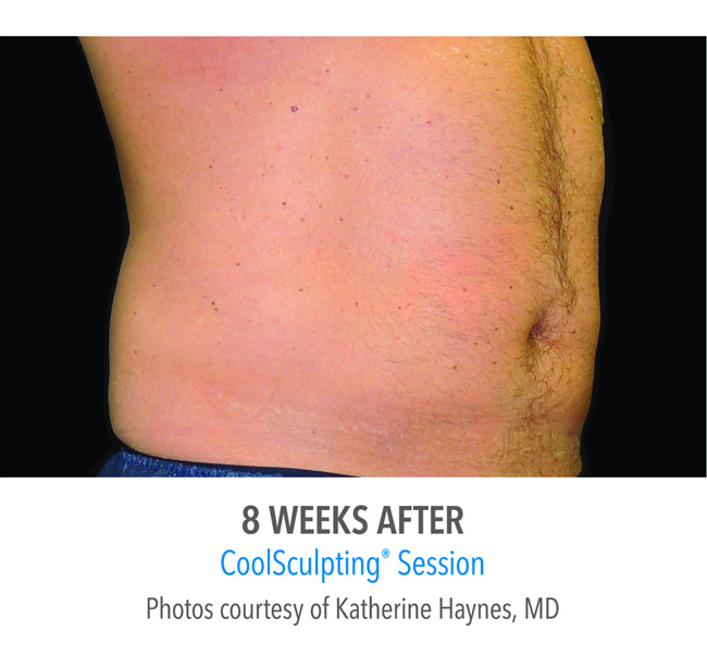 After-CoolSculpting