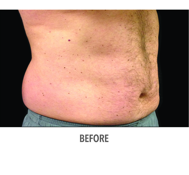 Before-CoolSculpting