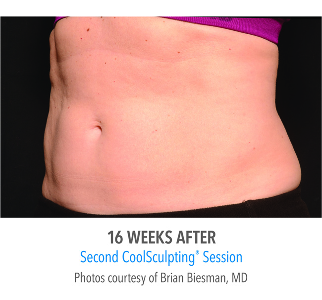 After-CoolSculpting