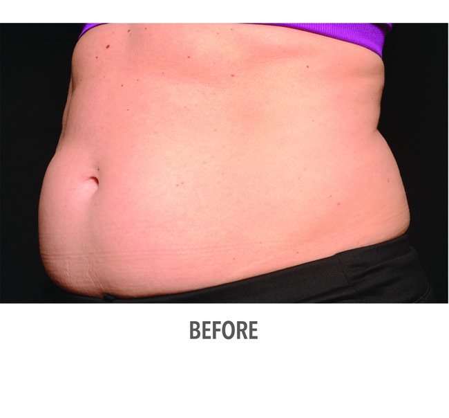 Before-CoolSculpting