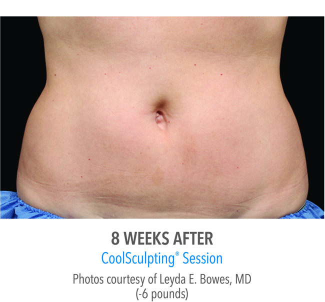 After-CoolSculpting