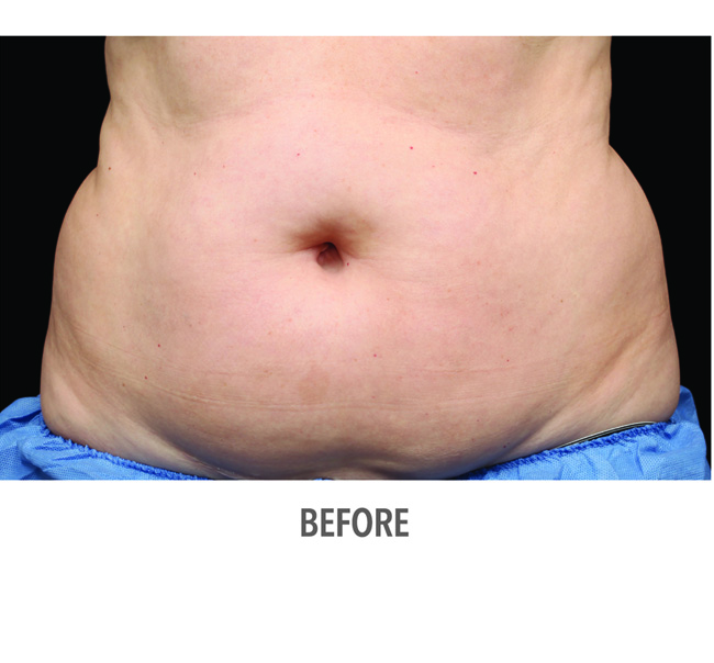 Before-CoolSculpting