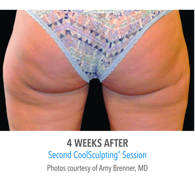 After-CoolSculpting