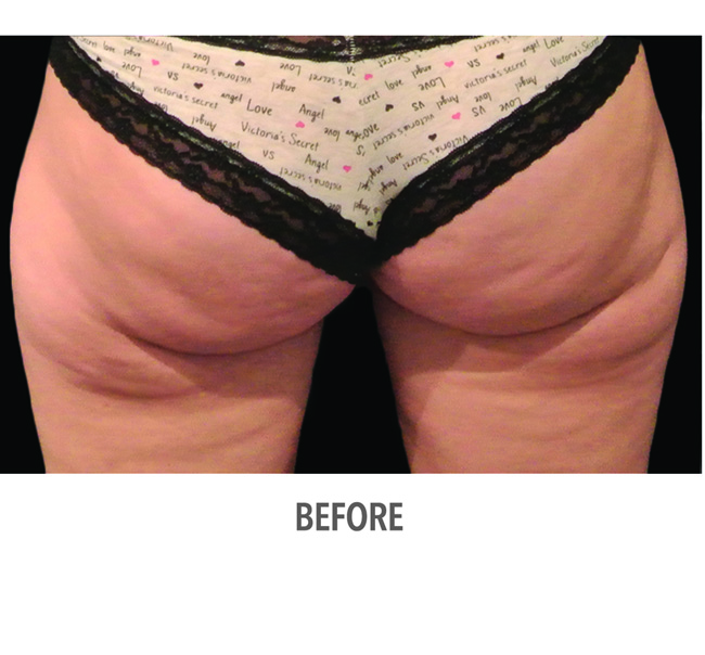 Before-CoolSculpting