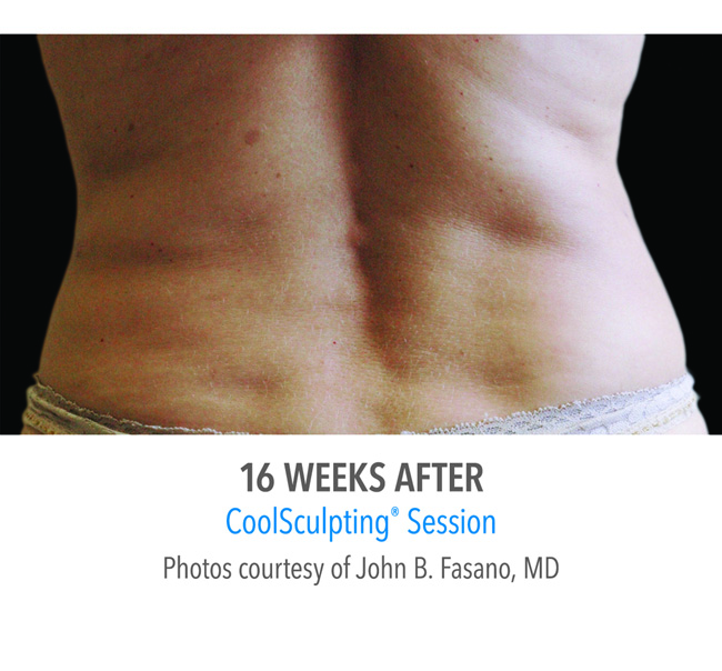 After-CoolSculpting