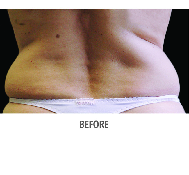 Before-CoolSculpting