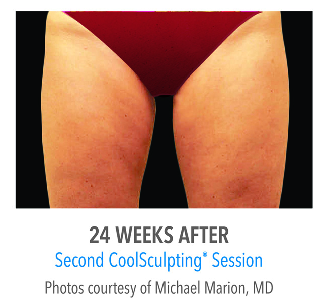 After-CoolSculpting