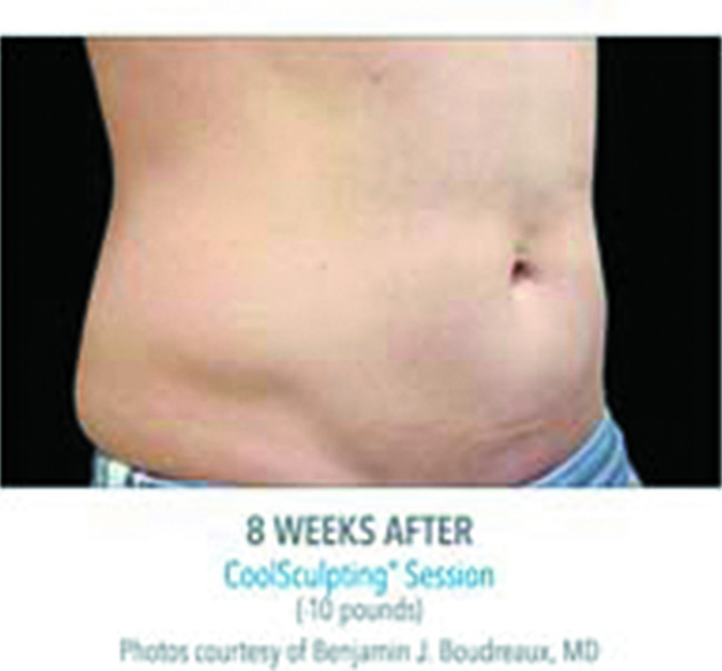 After-CoolSculpting