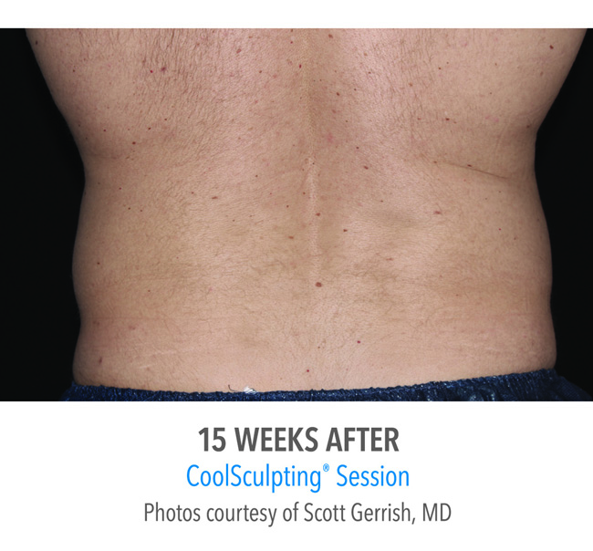 After-CoolSculpting