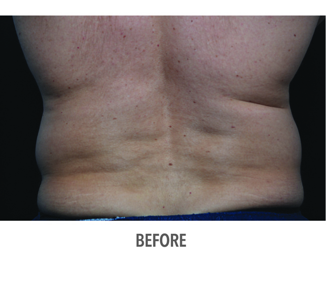 Before-CoolSculpting