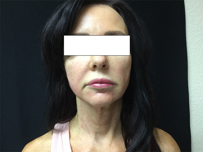 After-NovaThread Lift
