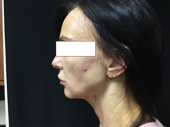 After-NovaThread Lift