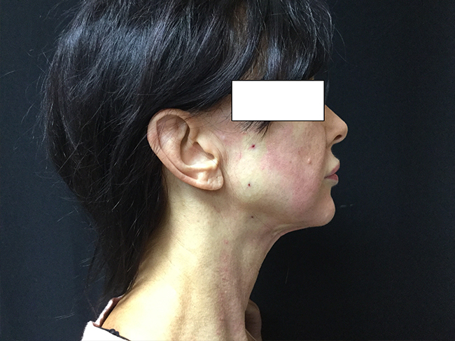 After-NovaThread Lift