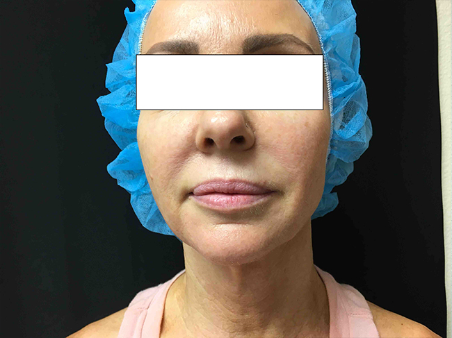 Before-NovaThread Lift