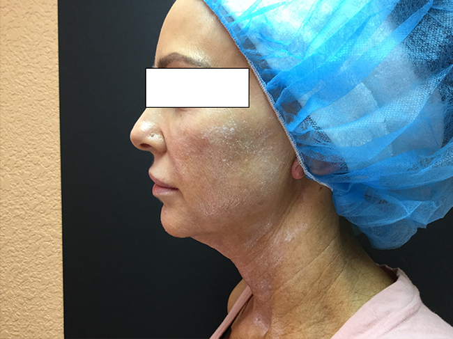 Before-NovaThread Lift