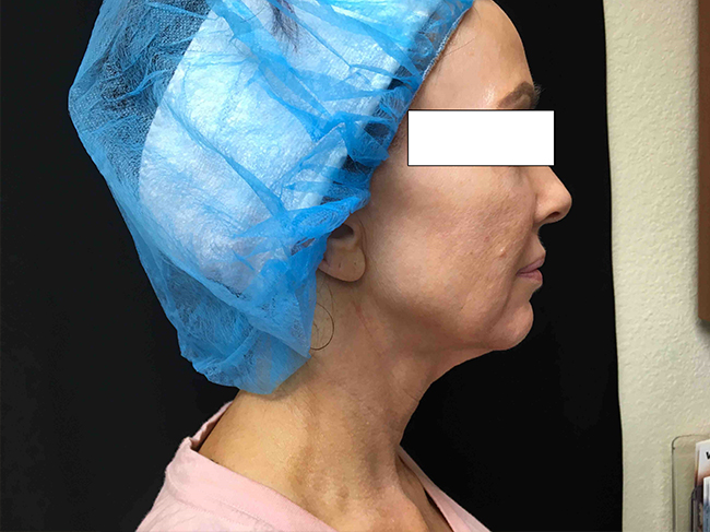 Before-NovaThread Lift