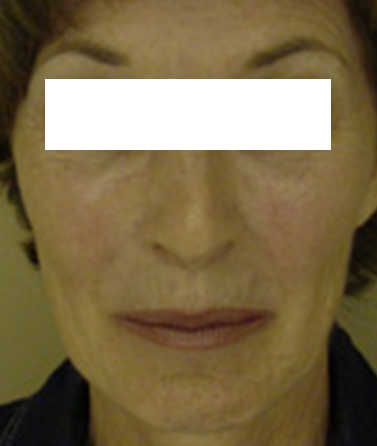 Before-Laser Skin Resurfacing