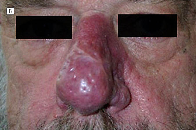 After-Rhinophyma