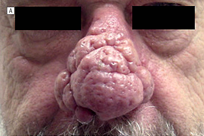 Before-Rhinophyma