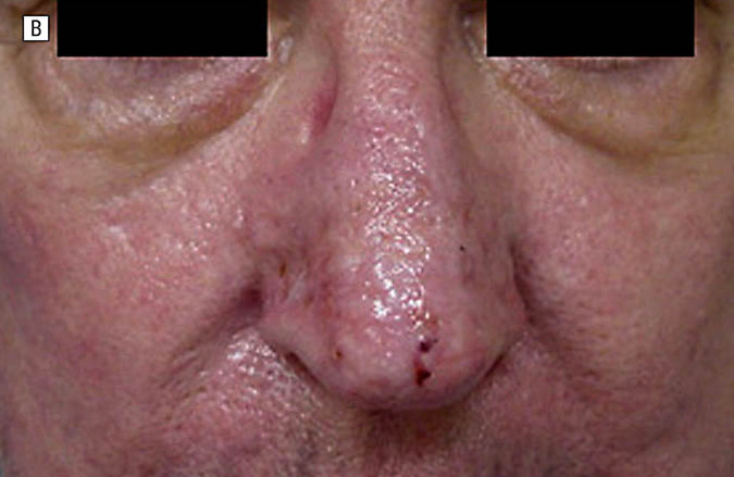 After-Rhinophyma