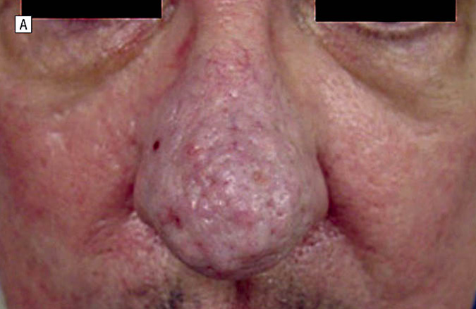 Before-Rhinophyma