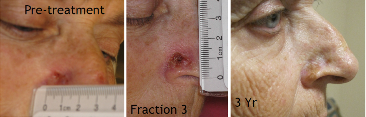 Electronic Brachytherapy Before and After Pictures San Ramon, CA