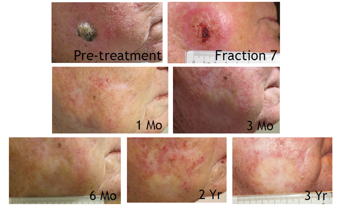 Electronic Brachytherapy Before and After Pictures San Ramon, CA