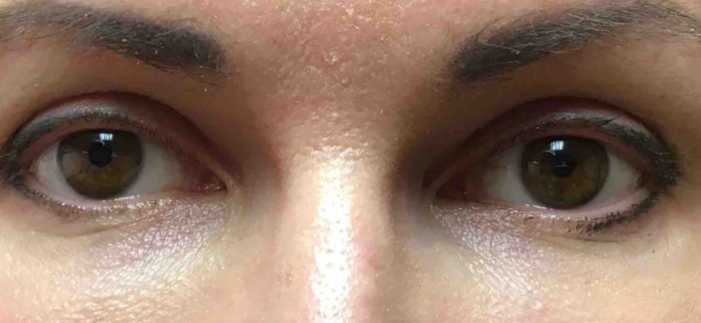 After-Periorbital Filler