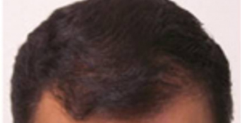 After-Hair Restoration
