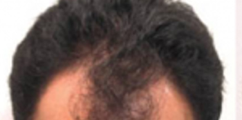 Before-Hair Restoration