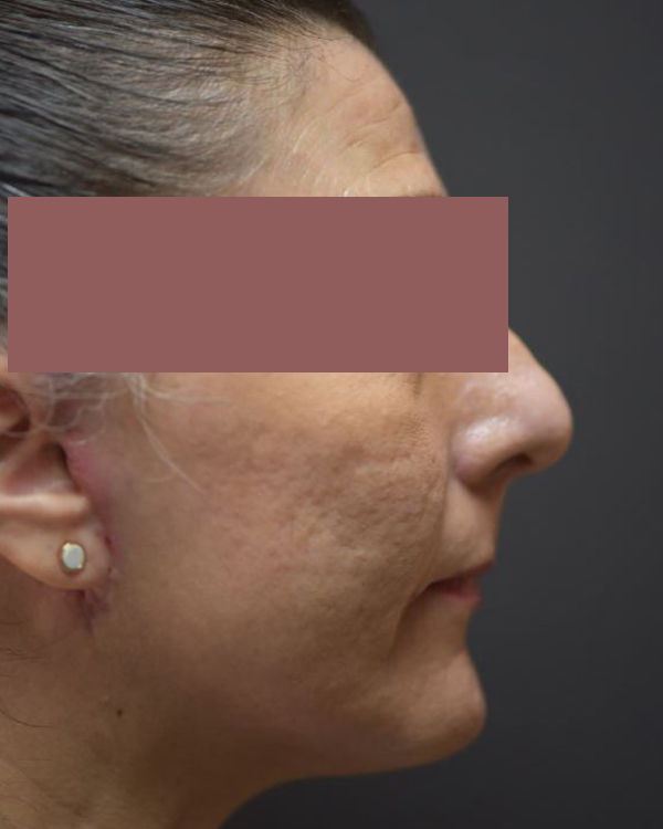 After-G Lift - Right