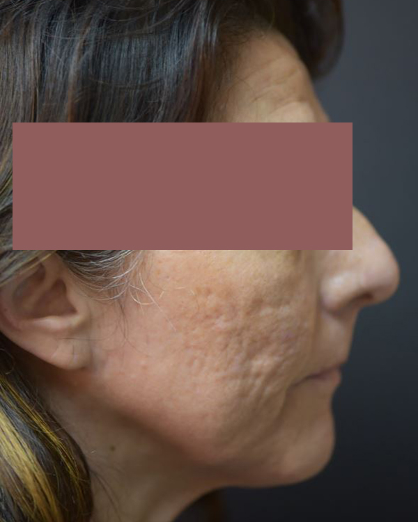 Before-G Lift - Right