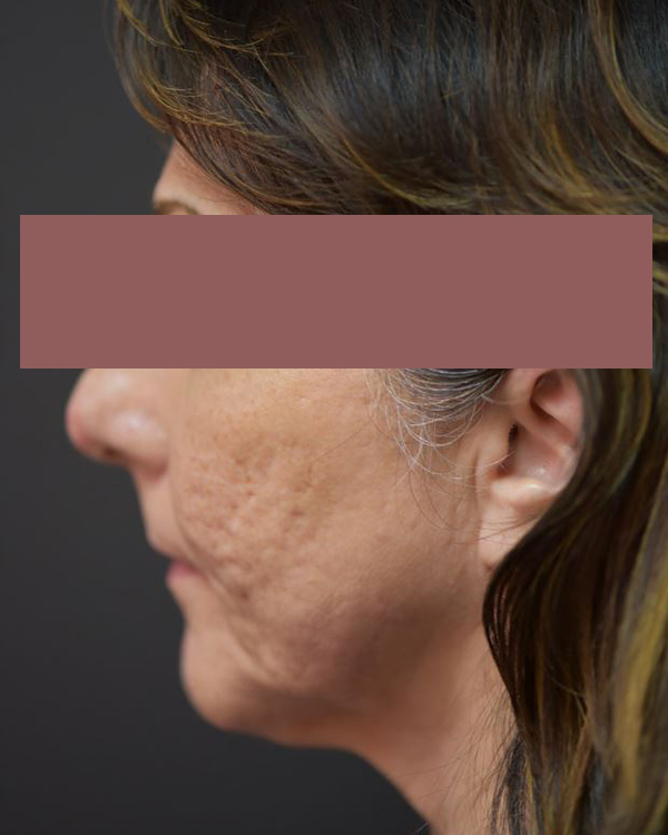 Before-G Lift - Left