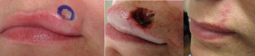 Lip Reconstruction surgery in San Ramon and Manteca CA