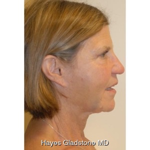 After-Liquid Facelift