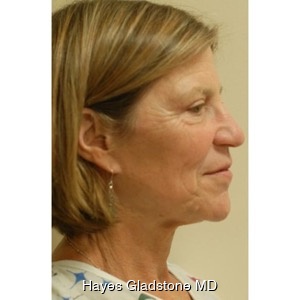 Before-Liquid Facelift