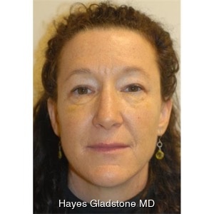 After-Liquid Facelift