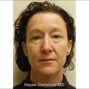 Before-Liquid Facelift