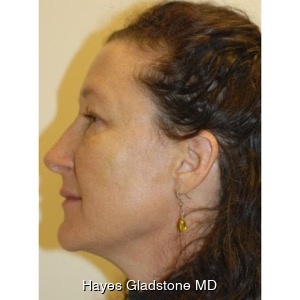 After-Liquid Facelift